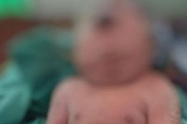 Kisah Haru! Bayi Lahir Tanpa Hidung dan Bermata Satu di Wawonii